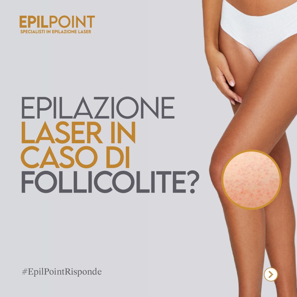 epilazione laser e follicolite