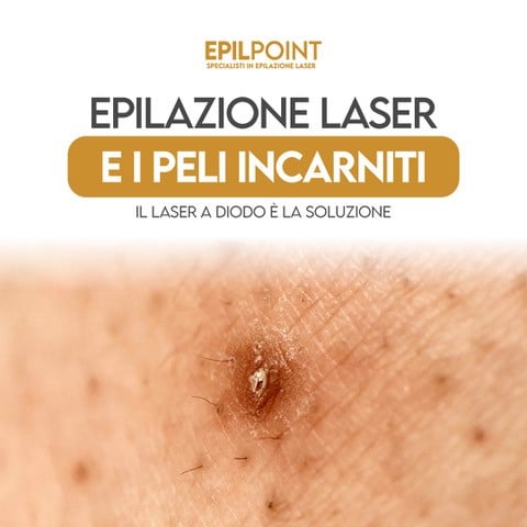 epilazione laser e peli incarniti