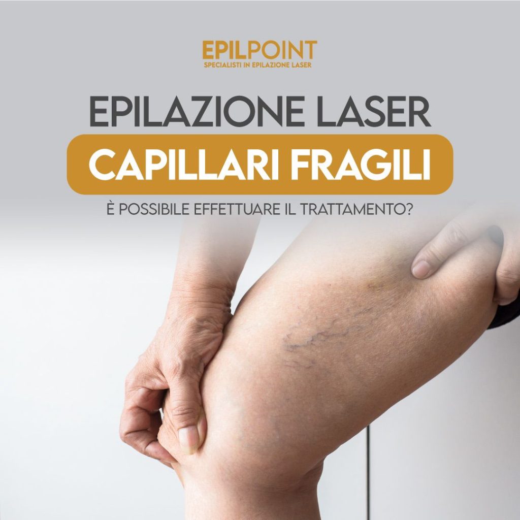 epilazione laser e capillari fragili