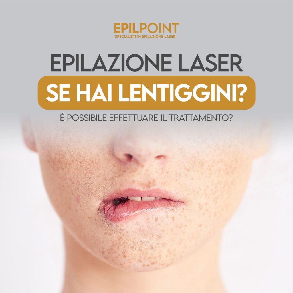 epilazione laser se hai le lentiggini