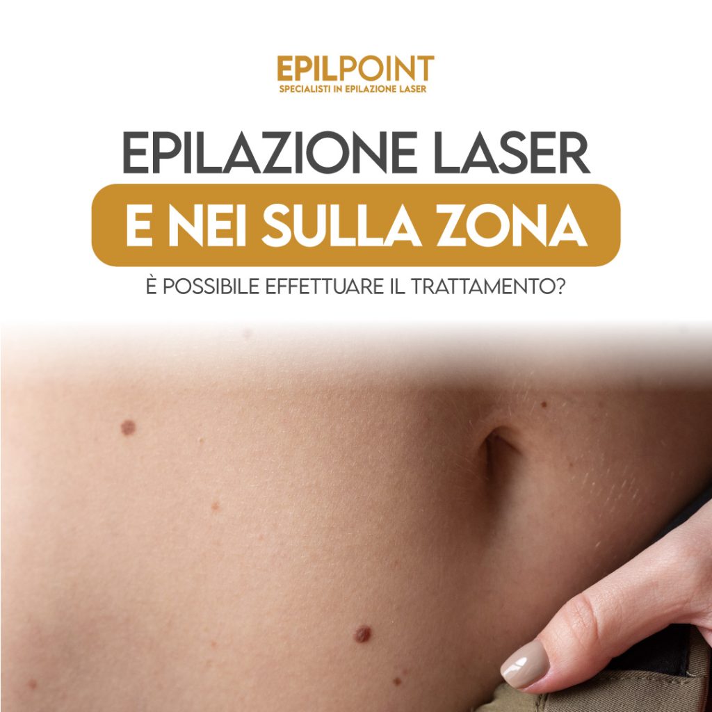 epilazione laser e nei sulla zona