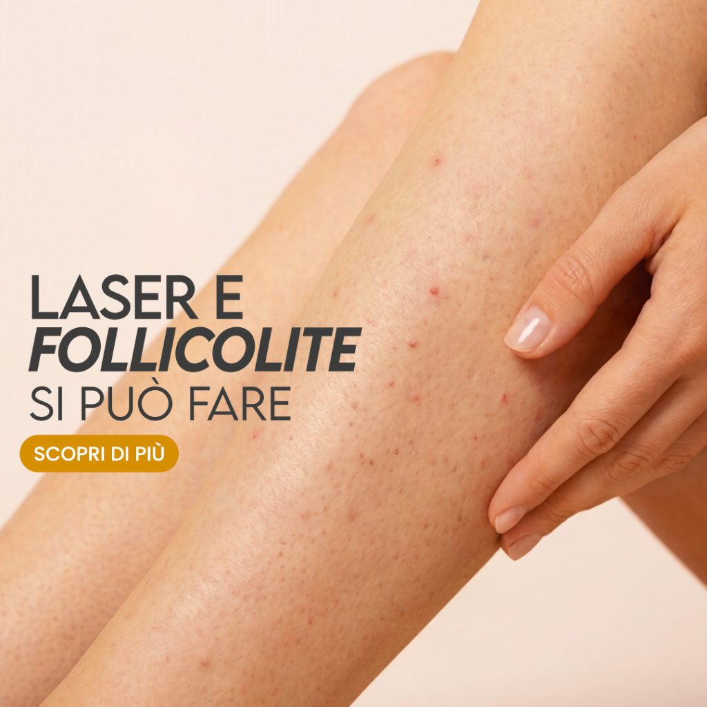 laser e follicolite